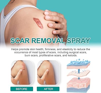 Scar Spray Z360